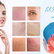 Red Light Therapy: Easing Redness After Cosmetic Laser Treatments