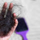 hair loss-treatment