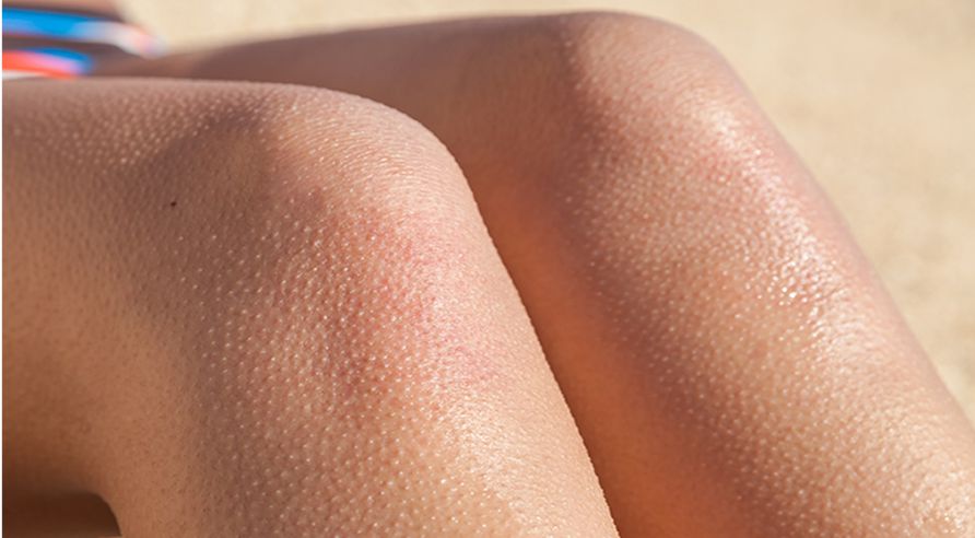 keratosis pilaris-treatment