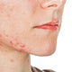 Can Phototherapy Treat Rosacea? A Comprehensive Overview Based on Current Research