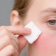 Skin Barrier Damage and Repair: The Critical Role of Skin Lipids and Microbiome