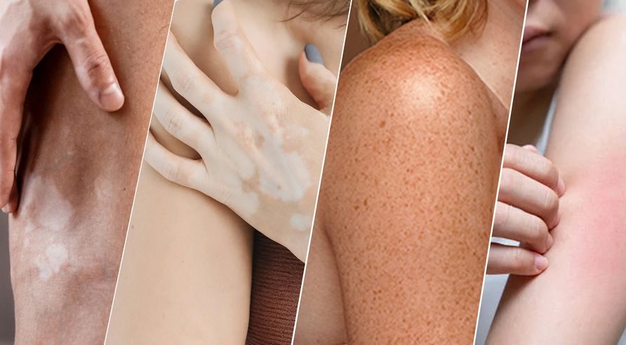 white spot-skin-psoriasis-treatment
