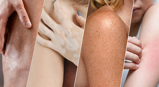 white spot-skin-psoriasis-treatment