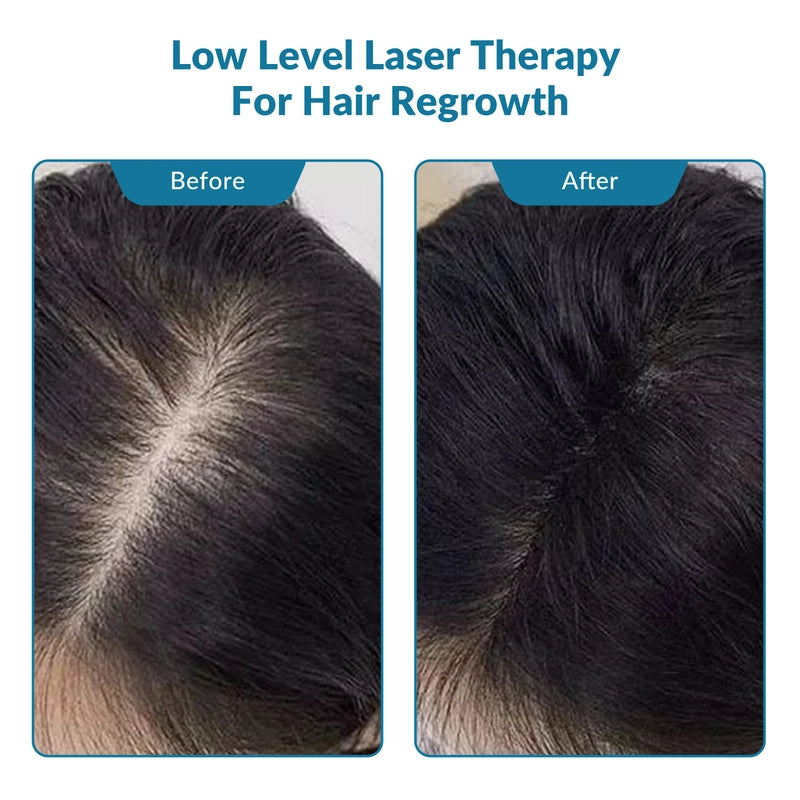 ZJKC 650nm Red Light Therapy Laser for Hair Regrowth Hair Loss Treatment Helmet