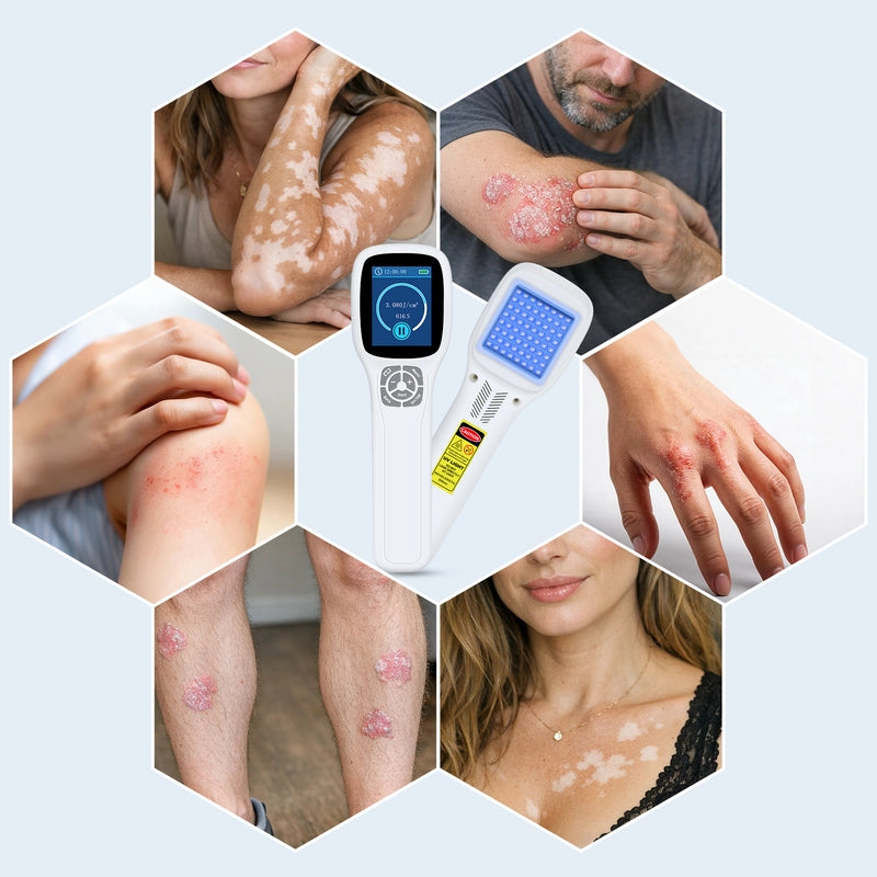 Handheld Excimer UVB Light Therapy 308nm Home Phototherapy Device –Relief for Vitiligo, Psoriasis & Dermatitis