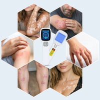 ZJKC Handheld Excimer UVB Light Therapy 308nm Home Phototherapy Device Relief for Vitiligo, Psoriasis & Dermatitis