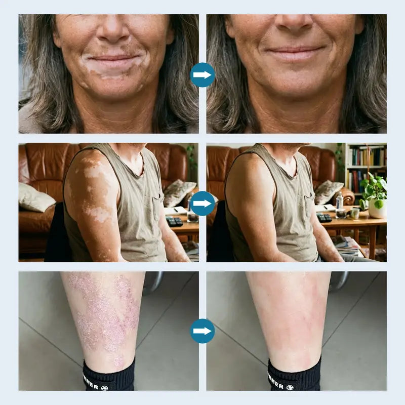 Handheld Excimer UVB Light Therapy 308nm Home Phototherapy Device –Relief for Vitiligo, Psoriasis & Dermatitis