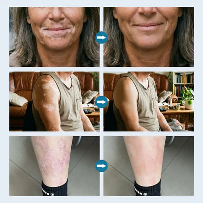 Handheld Excimer UVB Light Therapy 308nm Home Phototherapy Device –Relief for Vitiligo, Psoriasis & Dermatitis