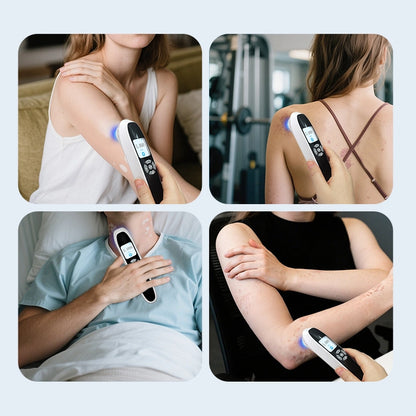 Handheld 308nm Excimer UVB Lamp – High Intensity, High Targeting Light Therapy for Vitiligo