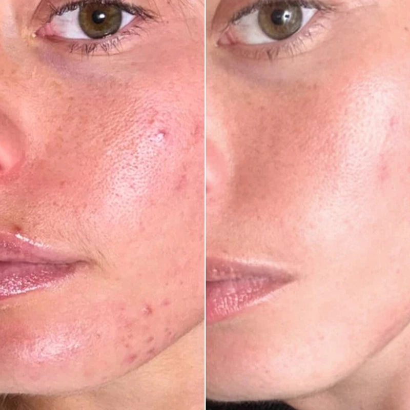 led_light_for_pigmentation_result_result8.19